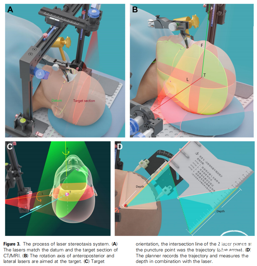 新型激光无框架定位技术论文发表在World Neurosurgery杂志